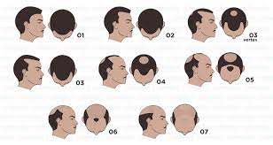 Hair Transplant in Turkey | ClinMedica - Hair Transplant in Turkey
