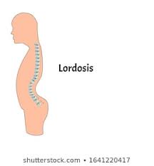 Lordosis Images, Stock Photos & Vectors | Shutterstock