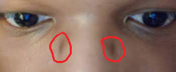 Skin Concerns] How do I get rid of these dark spots that my glasses  nosepads seemingly caused? It's much more visible in person. :  r/SkincareAddiction