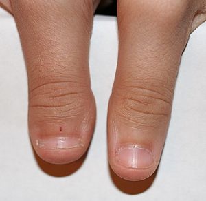300px-Clubbed_thumb.jpg