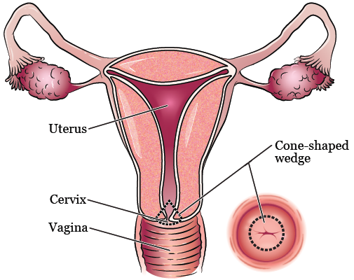 cone_biopsy-fig_1-en.png