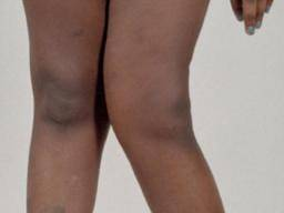 genu-valgum-or-knock-knees.png