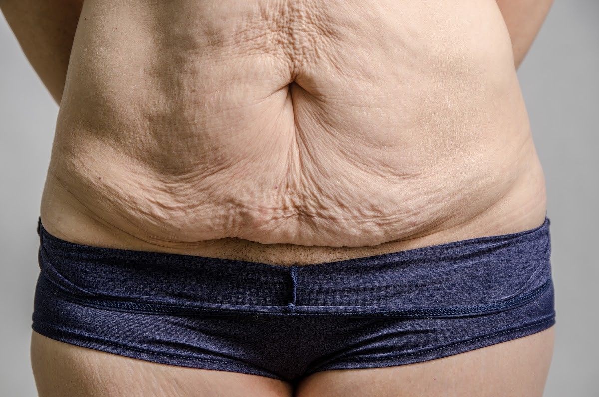 weight-loss-saggy-skin-plastic-surgery-after-weight-loss.jpeg