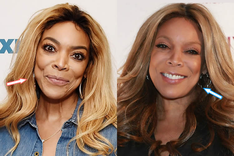 wendy-williams-facelift.jpg