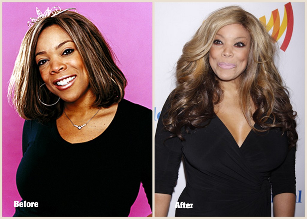 Wendy-Williams-Plastic-Surgery-1024x731.jpg
