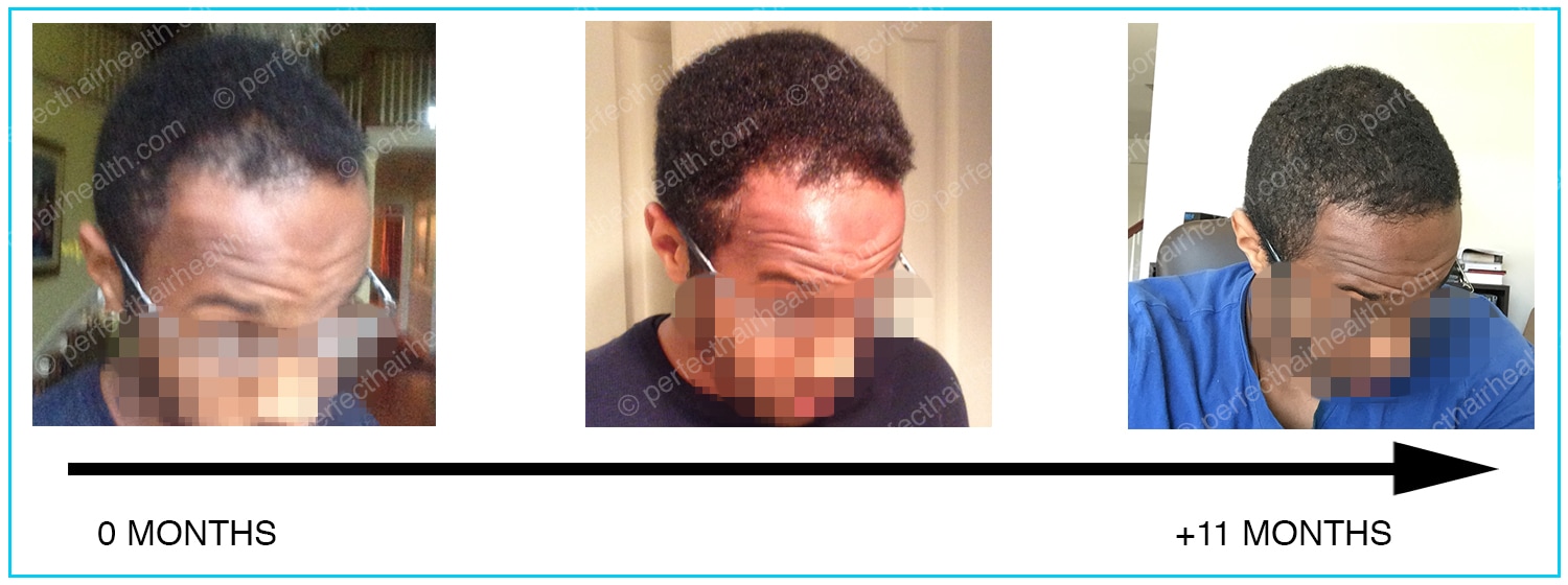 Natural-hairline-regrowth_WM.jpg