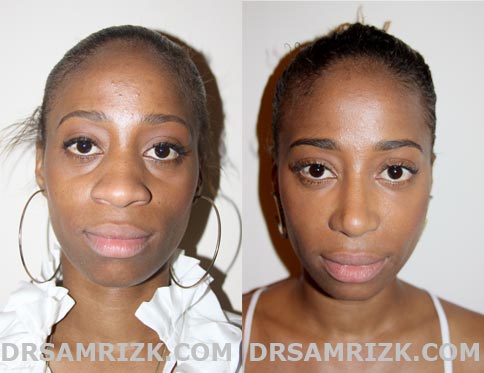 afr-rhinoplasty1.jpg