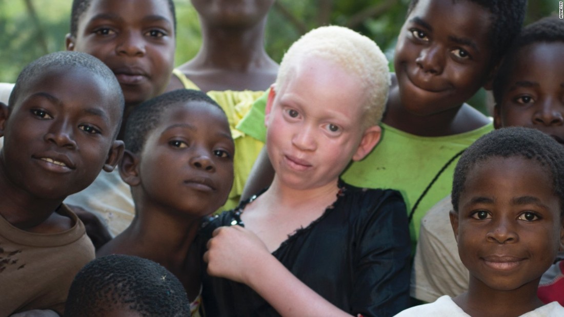 160607131802-malawi-albinos-02-super-169.jpg