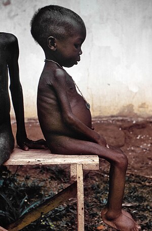 300px-Starved_girl.jpg