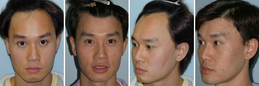 HairLineLoweringMan2.png