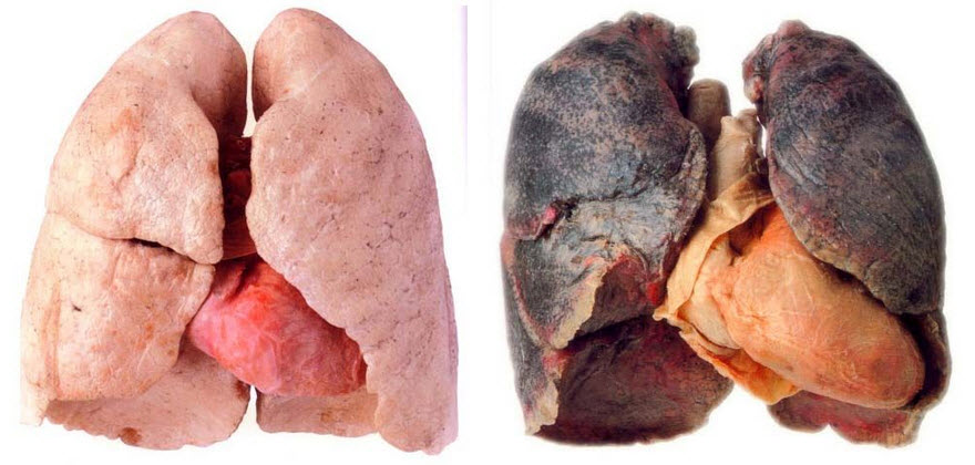 lungs.jpg