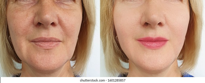 woman-wrinkles-face-after-treatment-260nw-1601285857.jpg