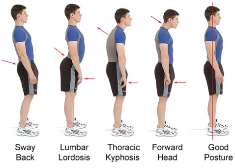 Lordosis | Physiotherapy and Recovery