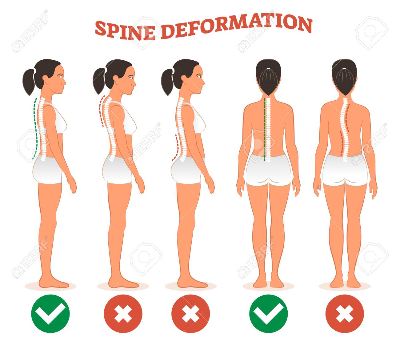 99334702-spine-deformation-types-and-healthy-spine-comparison-diagram-poster-with-back-bone-curvatures-female.jpg