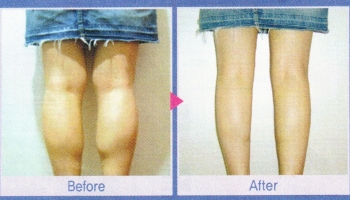 korean-calf-reduction-surgery-advertisement-before-after.jpg