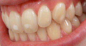 300px-Dental_fluorosis_%28mild%29.png