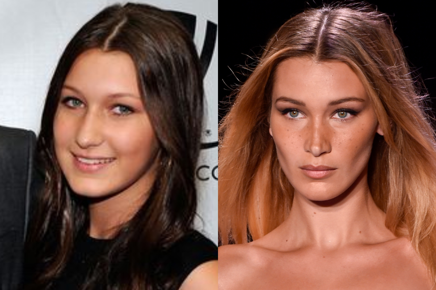 bella-hadid-before-and-after-plastic-surgery-1500-1000.jpg